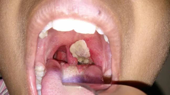 Diphtheria kills 453 persons in 18 States –&nbsp;FG