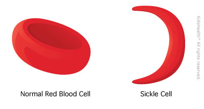 Sickle Cell Disease Treatment Approved For English NHS